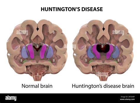 Dorsal Striatum And Lateral Ventricles In Healthy Brain And In