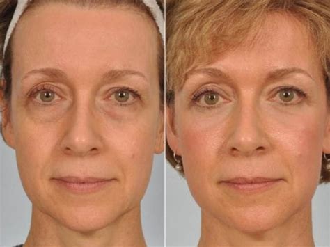 Laser Skin Resurfacing Philadelphia Pa W Cosmetic Surgery