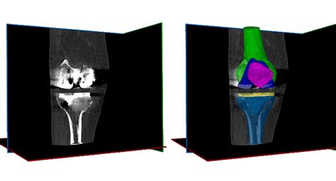 RSIP Vision Announces Metal Implant Anatomical Segmentation Tool