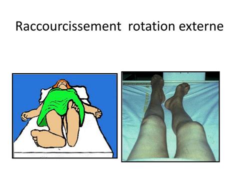 PPT Les fractures du col du fémur Anatomie et physiologie de l