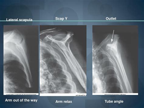 Outlet View Of Shoulder Joint Labeled Sema Data Co Op