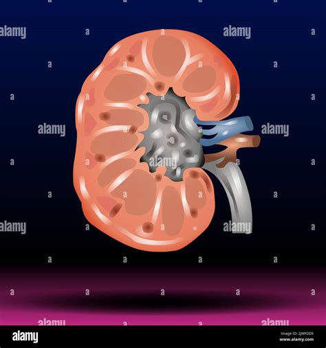 Kidney Internal Organ Kidney Stones Renal Calculi Nephrolithiasis