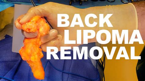 Lipoma Removal - Dr. Paul Ruff | West End Plastic Surgery - YouTube