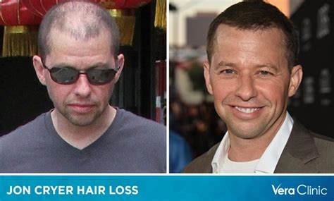 Jon Cryer Hair Loss and the Career Highlights