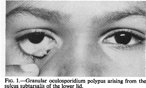 Figure From Rhinosporidiosis Of The Eye Semantic Scholar