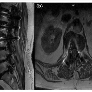 A Sagittal And B Axial Preoperative T2 Weighted MRI Of A Patient In