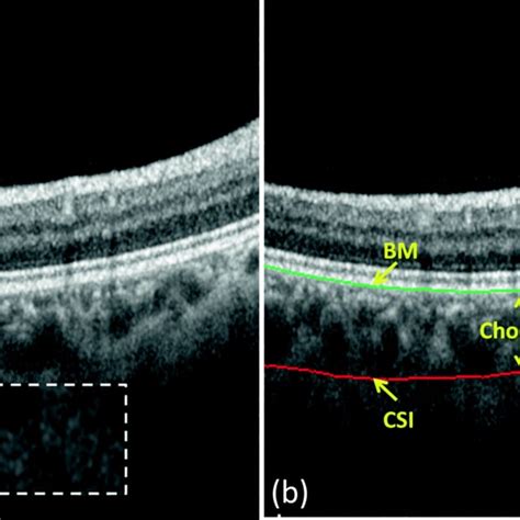 The Subfoveal Choroidal Thickness Sfct A Normal Oct B Scan B