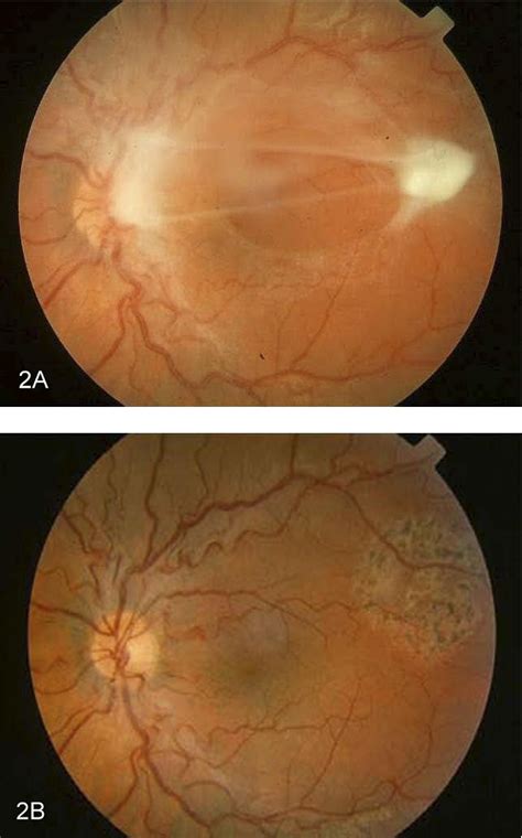 Ocular Toxocariasis Epidemiologic Anatomic And Therapeutic