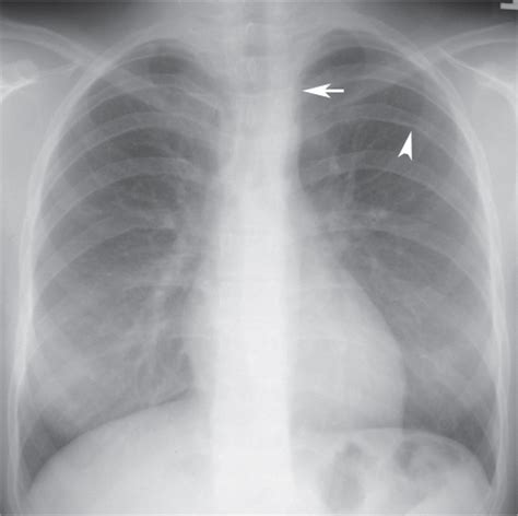 5 Coarctation of the Aorta | Radiology Key