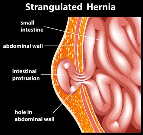 Open Vs Laparoscopic Hernia Repair Understanding The Differences