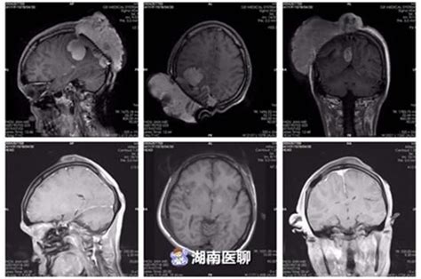 女子後腦勺長近20厘米腫瘤，腫瘤已經爆開，不忍直視！ 壹讀