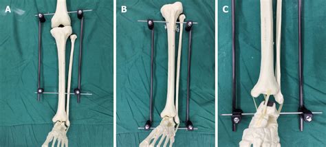 Early Complications Of Preoperative External Traction Fixation In The Staged Treatment Of Tibial