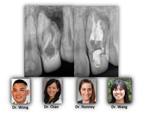 "Dens in dente"- Renovo Endodontic Studio