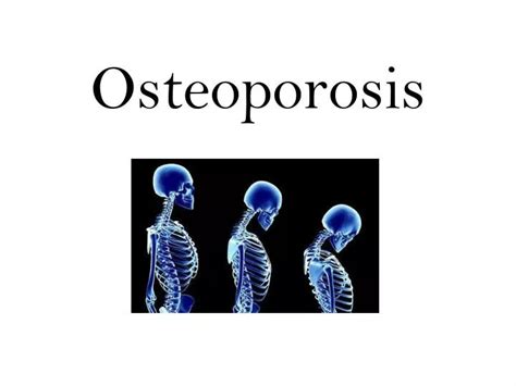 Ppt Osteoporosis Powerpoint Presentation Free Download Id2420479