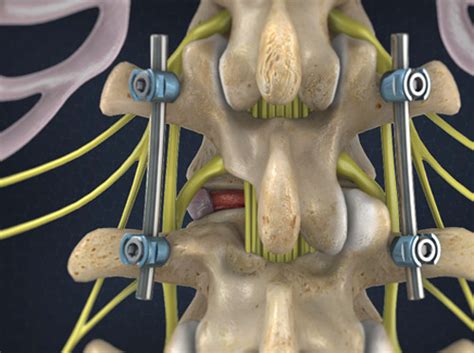 Video Minimally Invasive TLIF Transforaminal Lumbar Interbody Fusion