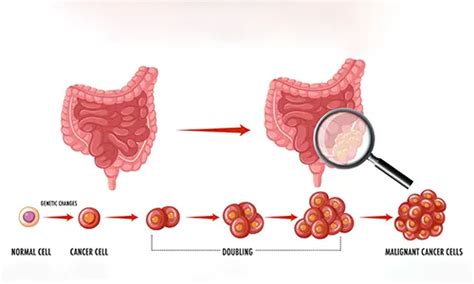 Intestinal Cancer Symptoms Diagnosis Treatment And Risk Factors Moc