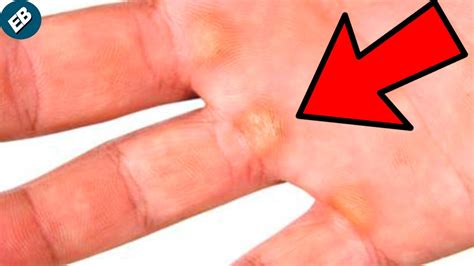 Como Quitar Callos De La Mano Consejo Educativo Uru