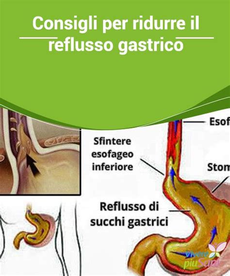 Consigli Per Ridurre Il Reflusso Gastrico Cause Del Reflusso