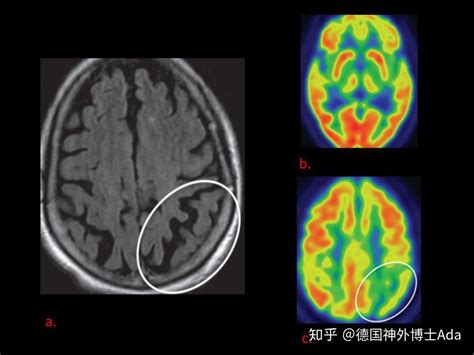 影像图谱｜帕金森病和帕金森综合征的影像 知乎