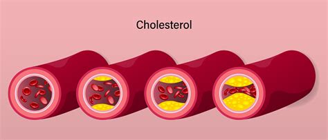 Stage Of Cholesterol Accumulation In Blood Vessels Atherosclerosis