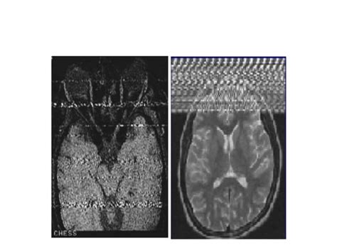 Mri Artifact Radiology Ppt