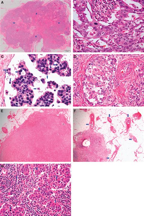 Histological Factors Of The Modified Pvn Classification Ag A