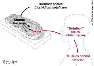 Botulism Guide Causes Symptoms And Treatment Options