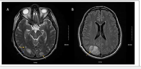 Mri Of The Brain With Multiple Brain Abscesses Secondary To Septic Download Scientific Diagram