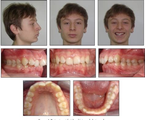 Figure 5 From Treatment Of Class II Division 2 Malocclusion Using The