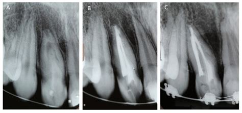 Radiographic Examinations Of Case 2 A Maxillary Lateral Incisor Download Scientific Diagram