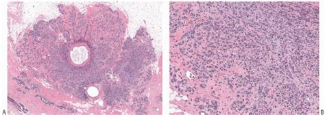 Adenosis And Microglandular Adenosis Basicmedical Key