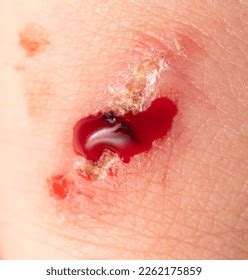 Wound On Human Skin Macro Stock Photo 2262175859 Shutterstock