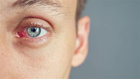 Here’s why your eye pain might actually be an STI – Total News