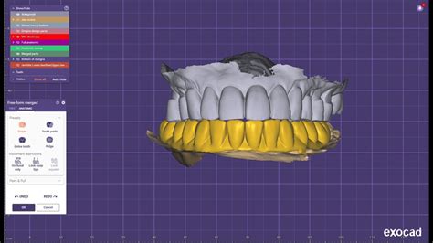 Exocad Elefsina Designing For Upper Lower Full Arch Pmma Temporary