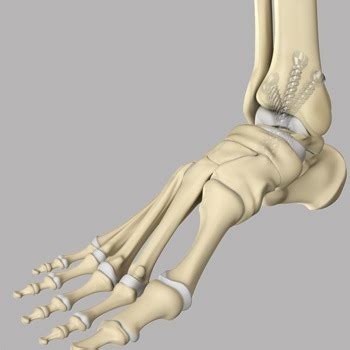 Ankle Arthrodesis Stockton | Ankle Arthritis Modesto