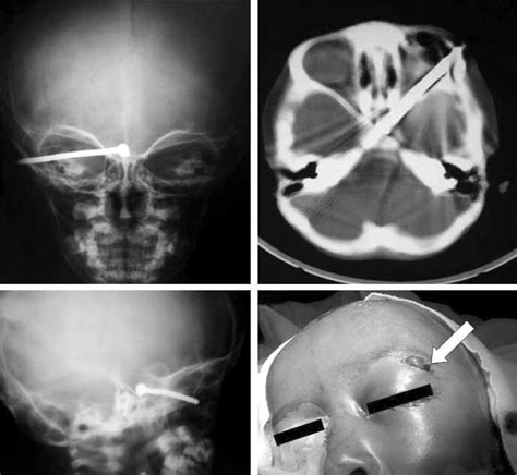 Antero Posterior A And Lateral B Cranial Plain Radiographs Of The Download Scientific