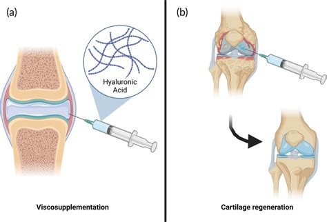 Treatment Of Cartilage Defects Caused By Osteoarthritis A