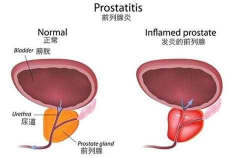 前列腺炎的症状到底有哪些？ 知乎