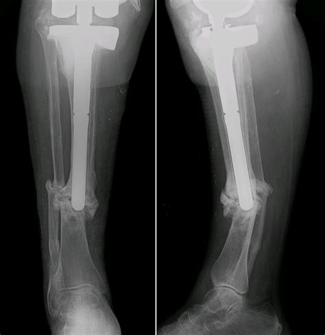 Fractura De Tibia Y Peron Camde