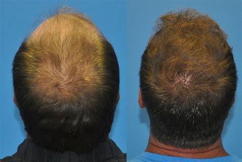 Norwood Class IV Hair Loss 3000 FUE Hair Grafts Carolina Hair Surgery