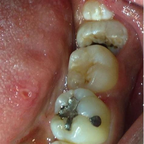 Pdf Mandibular Third Molar Retained And Fused With A Supernumerary