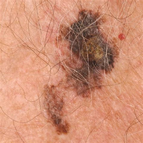 What Is Melanoma Leeds Teaching Hospitals Nhs Trust