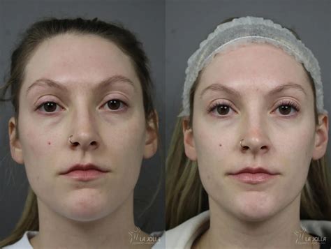 Sculptra® Before And After Gallery Patient 1