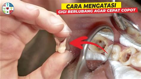 Cara Mengobati Gigi Berlubang Supaya Tidak Sakit