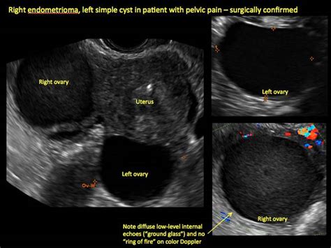 Symptoms Of Endometrial Cyst