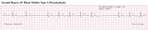 ECG Educator Blog : Second Degree AV Block Mobitz Type I (wenckebach)