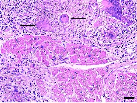 Histologic Image Of An Endomyocardial Biopsy From A Patient With Giant