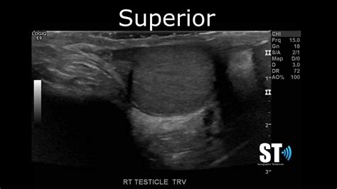 Testicular Scrotal Doppler Protocol Sonographic Tendencies