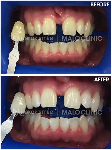 Ideal Teeth Bleaching Products Of According To Dentists