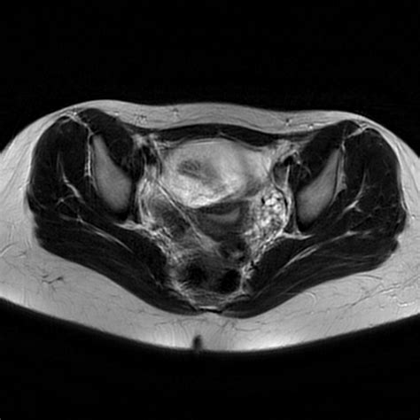 Ovarian Dermoid Image